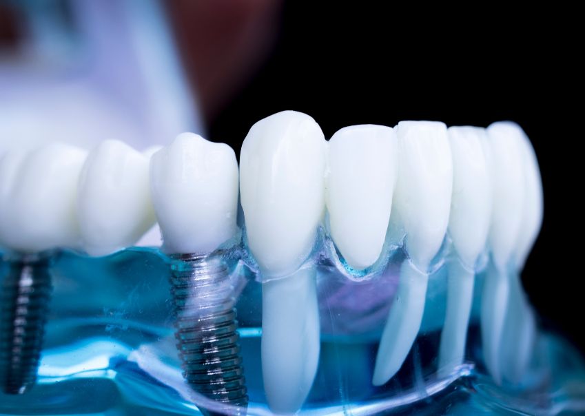 Conventional Dental Implants vs TTPHIL Implant Technique