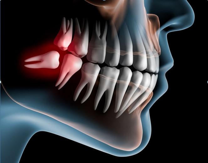 5 Reasons To Get Your Wisdom Tooth Removed