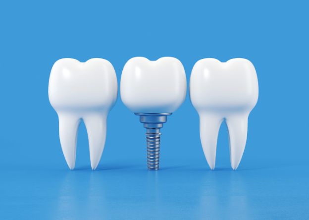 What Are Dental Implants?? 