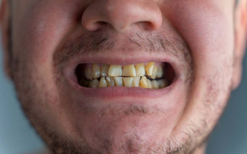Chromogenic Teeth Staining