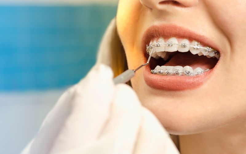 5 Myths about getting Dental Braces being an Adult