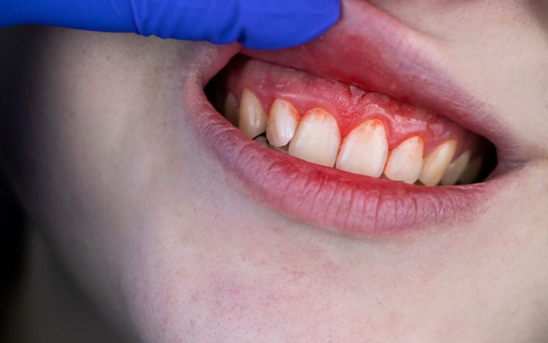 Why Are My Gums Bleeding When I Floss?