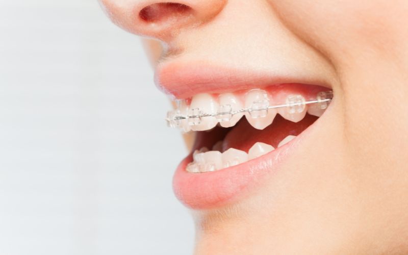 Types of Dental Braces in India