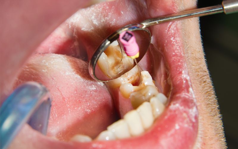 Is Root Canal Treatment a Painless Procedure?