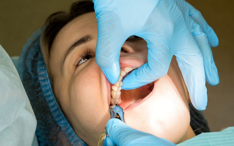 Does Wisdom Tooth Removal Change Shape of Your Face or Gums/Bone?